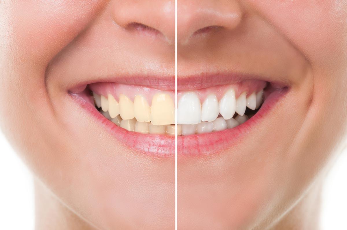 Peut T On Blanchir Des Fausses Dents Dentisterie esthétique et facettes | Le sourire c'est notre métier à Votre  Dentisterie